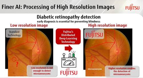 IA para detectar la retinopatía diabética