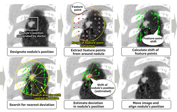 Figure 3: Alignment of nodule’s positions by the newly developed method