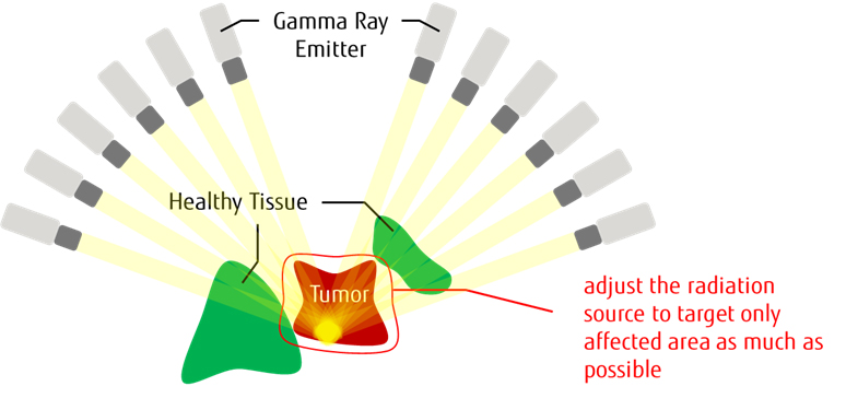 Fig. 1 Overview of Gamma Knife Therapy