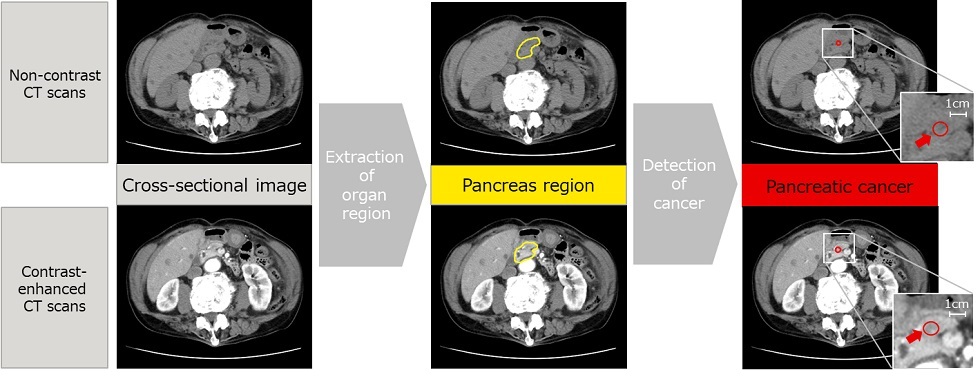 Figure 1: Detection of suspected pancreatic cancer using the newly developed technology